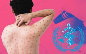 OMS lanza plan estratégico de preparación y respuesta contra el mpox